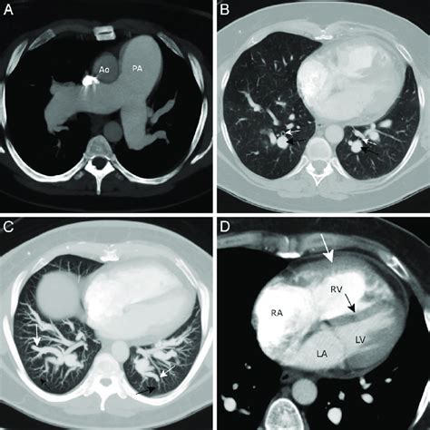 Idiopathic Pulmonary Arterial Hypertension Pah In A Year Old