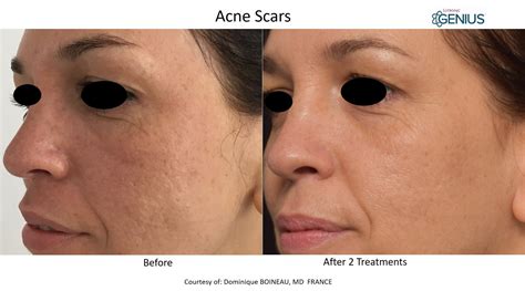 Genius Rf Microneedling Acne Scar Treatment Skin Tightening