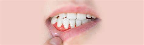 What is Gum Grafting: Procedure, Types, Benefits & Aftercare