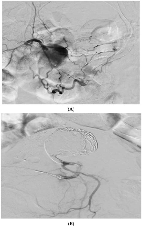 Embolization Of Large Internal Iliac Artery Pseudoaneurysm Through A