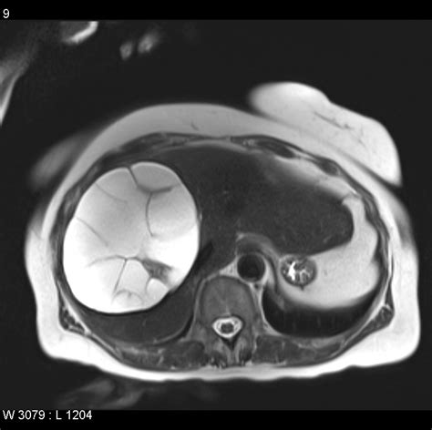 Liver Cyst MRI