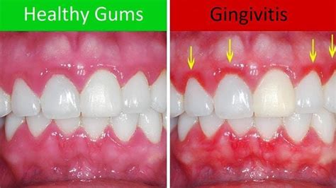 Gum Disease Fact Sheet Dentist Sunshine Coast Eumundi Dental