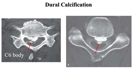 Ossified Posterior Longitudinal Ligament Opll Ppt