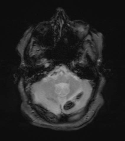 Early And Late Subacute Intracerebral Hemorrhage MRI Image