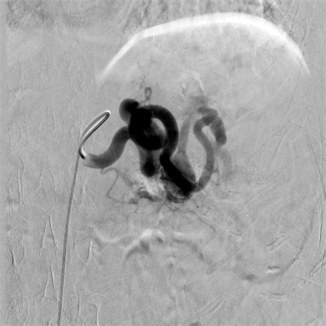 Tf Visceral Embolization Case Albany Ir