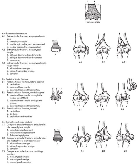 Classification Of Humerus Fractures