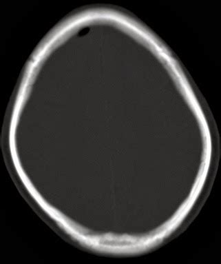 Dr Balaji Anvekar FRCR: Paranasal sinus osteoma CT