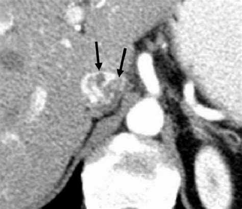 Ct Angiography Of The Ivc Axial Plane Showing A Filling Defect In The