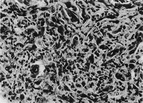 -Histology of undifferentiated angiosarcoma (lung metastasis). H.E. x ...