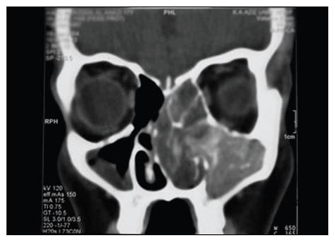 Allergic Fungal Sinusitis Radiological And Microbiological Features Of