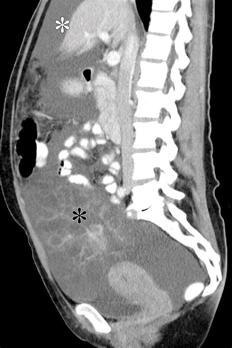 Mucinous Neoplasms Of The Ovary Radiologic Pathologic Correlation