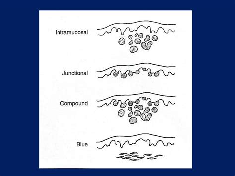 Benign Tumors Of Epithelial Origin Of Oral Cavity PPT