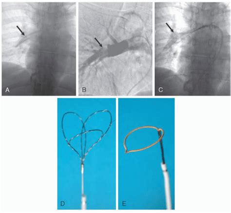 Pulmonary Angiography | Thoracic Key