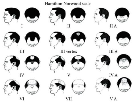 A Complete Guide To The Norwood Scale With 7 REAL Examples