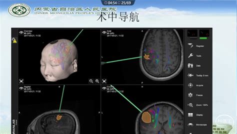 王忠教授：多模态功能神经导航联合术中荧光素钠辅助成像技术在颅内恶性肿瘤手术中的应用 脑医汇 神外资讯 神介资讯