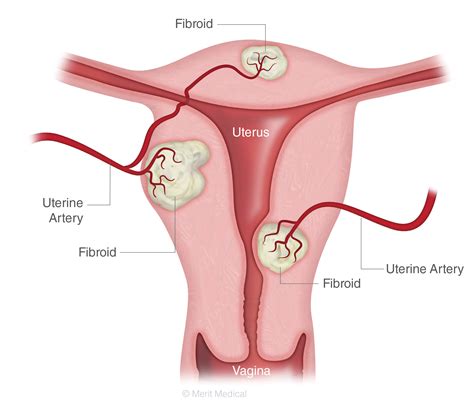 Uterine Fibroid Embolization South Jersey Lourdes Imaging Associates