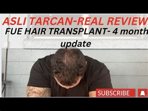 ASLI TARCAN REAL REVIEW FUE HAIR TRANSPLANT 4 MONTH UPDATE