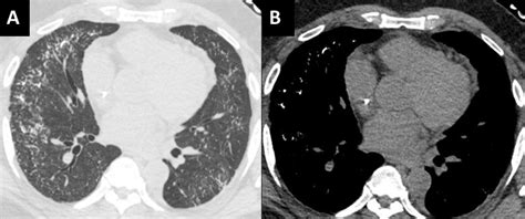 Southwest Journal Of Pulmonary Critical Care And Sleep Imaging December 2023 Medical Image