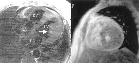 Computed Tomography And Magnetic Resonance Imaging Of Left Ventricular Thrombus Circulation