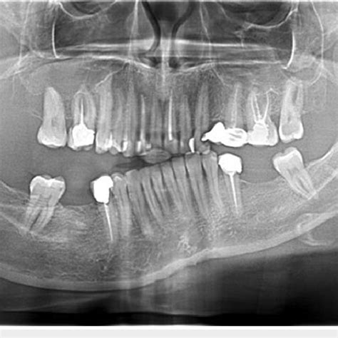 Panoramic radiograph of the mandible demonstrating an asymmetric ...