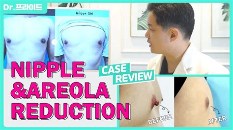 Nipple Areola Reduction For Man Youtube