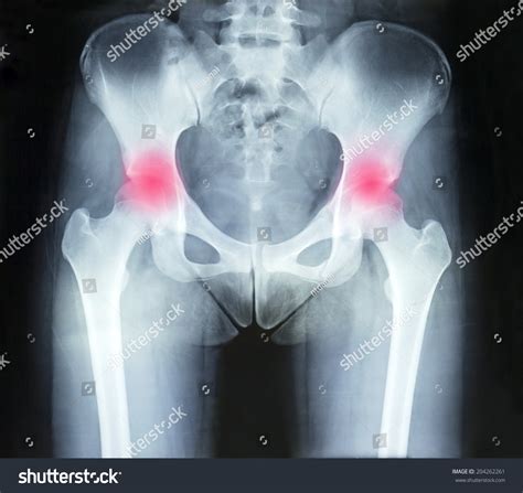 Film Xray Pelvis Arthritis Both Hip Stock Photo 204262261 Shutterstock