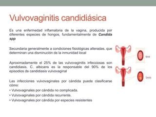 Infecciones Vaginales Por Bacterianas Y Hongos Pptx