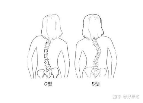 脊柱侧弯s弯和c弯哪个更严重 知乎