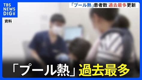 「プール熱」が過去最多を更新 1医療機関あたりの患者数「243人」 福岡など10道府県で「警報レベル」｜tbs News Dig Youtube