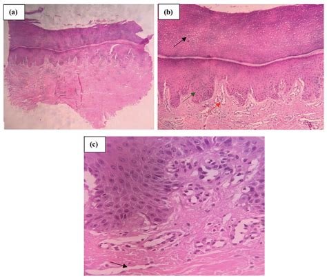 Biopsy Revealed Marked Orthokeratosis [black Arrow In B ] Acanthosis