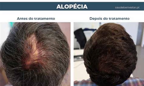 Qual é a causa da alopecia Leia aqui O que causa alopecia tem cura