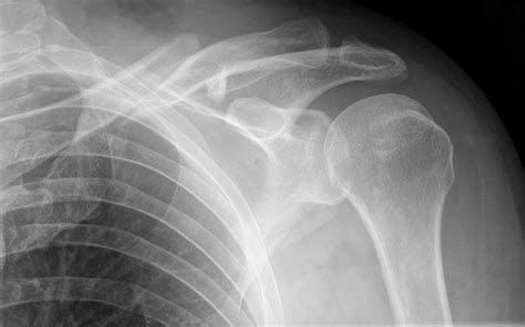 Broken left clavicle : r/brokenbones