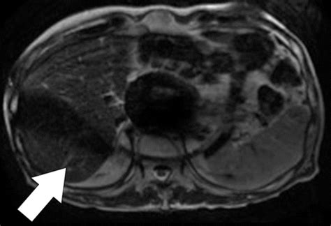 Body Mr Imaging Artifacts K Space And Solutions Radiographics