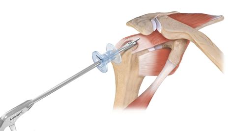 Illustrations Surgical Instructions Rotator Cuff Medicalgraphics