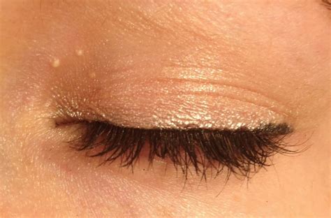 #milium – Dra. Monica Adoni Heller