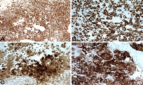 Sarcomatoid Urothelial Carcinoma With Choriocarcinomatous Features