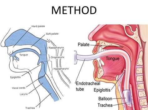 Intubation Endotracheal Tube Placement