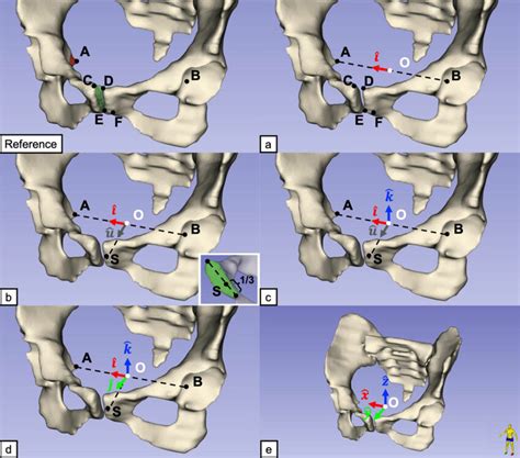 Establishment Of The 3D Pelvic Coordinate System For Reference The