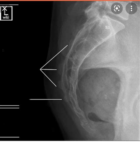 Sacrum Coccyx Diagram Quizlet