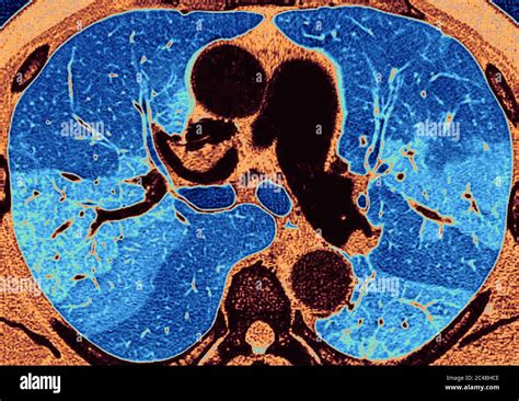 Fibrosis pulmonar histologia Banque de photographies et dimages à