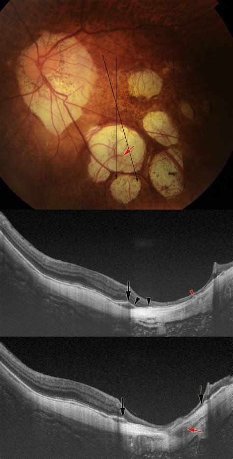 Macular Bruch Membrane Holes In Highly Myopic Patchy Chorioretinal Atrophy American Journal Of