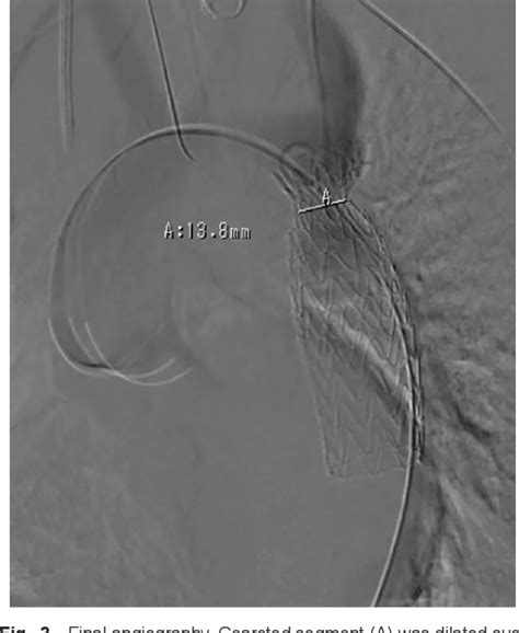 Figure 1 From Successful Two Stage Treatment For Coarctation Of The