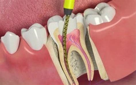 Leczenie kanałowe zęba na czym polega ile trwa ile kosztuje czy Hot