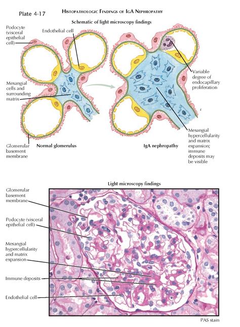 IGA NEPHROPATHY - pediagenosis