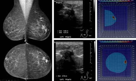 Case 1 From Left Mammography Mediolateral Oblique And Craniocaudal