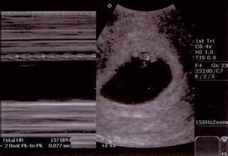 Cameron's Story: 05.05.08 Ultrasound Pics- 6 weeks, 4 days