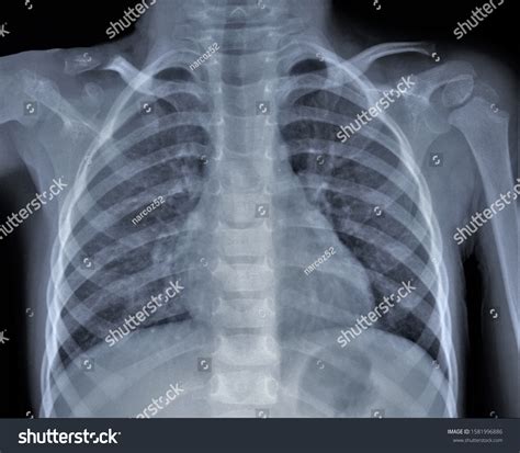 Fracture Acromial End Clavicle Child Xray Stock Photo (Edit Now) 1581996886