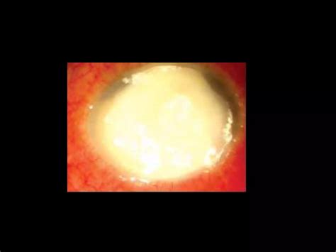 Corneal Ulcer Ppt