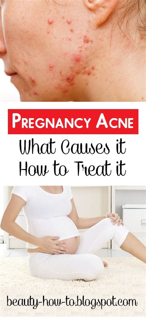 Pregnancy Acne What Causes It And How To Treat It How To Beauty