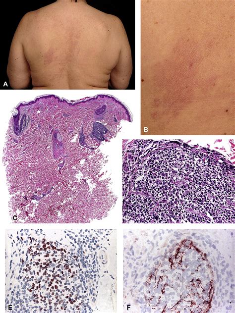 Clinicopathologic Features Of Early Lesions Of Primary Cutaneous